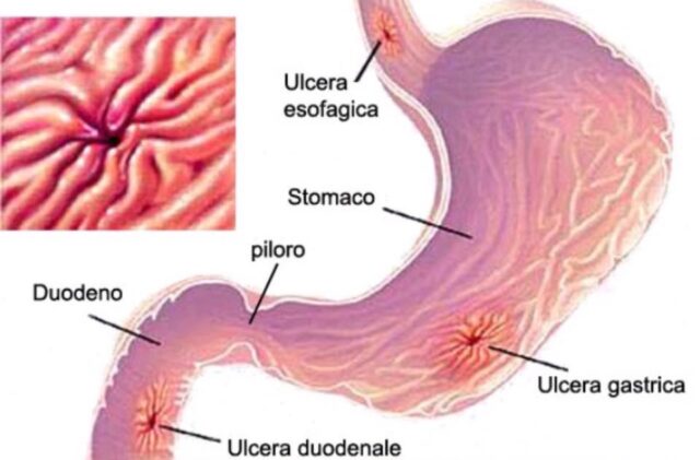 ulcera gastrica e ulcera duodenale
